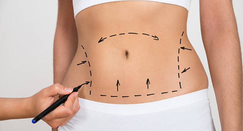 La lipoescultura es un procedimiento quirúrgico que consiste en eliminar el exceso de grasa localizada en diferentes zonas del cuerpo, como el abdomen o los brazos. (Base: Difusión)